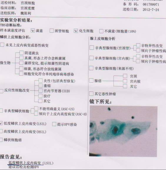 宫颈癌筛查tct正常报告单,宫颈癌筛查报告单怎么看tct