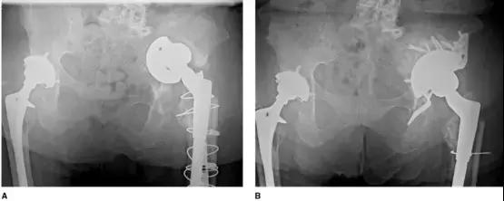 髋臼骨质破坏一般怎么治,髋臼骨缺损