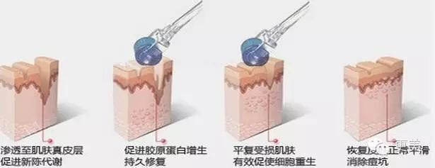 长痘痘好焦虑啊,长痘痘要用什么药治疗