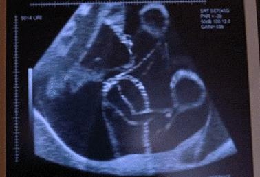 孕28周～孕32周第41课:如何数胎动