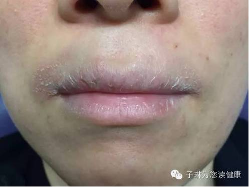 喝酒后嘴唇起皮裂口是怎么回事,嘴唇裂口起皮是什么原因