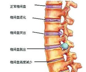 倒着走可以治疗腰间盘突出吗,腰间盘突出倒着走多长时间