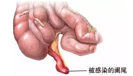 得了阑尾炎要不要割了阑尾,得了阑尾炎不管他会怎么样