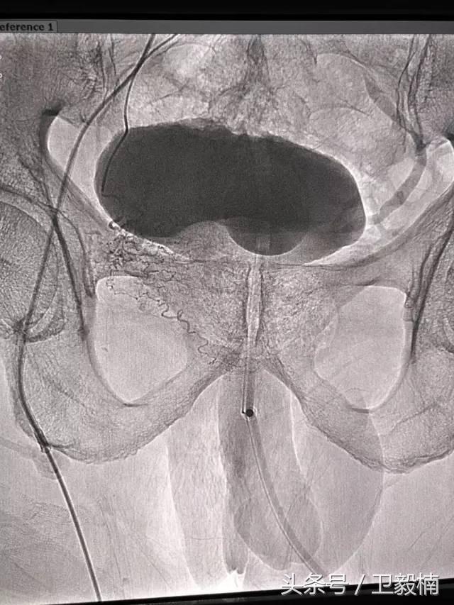微创介入科一卫毅楠,什么是心血管介入治疗