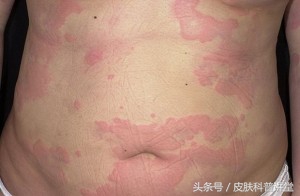 过敏原检测一般能不能查出过敏原,反复过敏怎么查过敏源