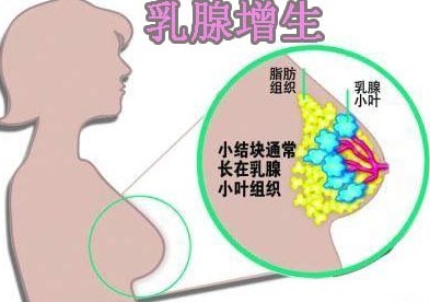 乳腺增生加囊肿的癌变几率和时间,乳腺导管上皮增生癌变几率