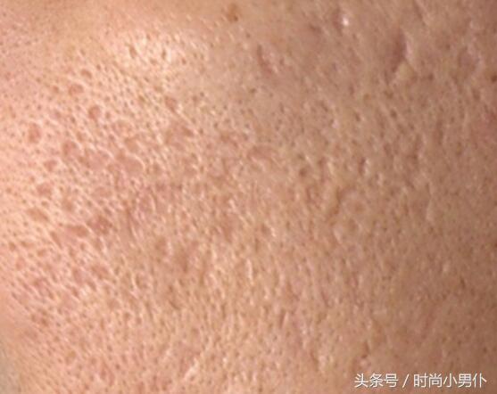 脸上像月球表面怎么修复,福建脸部坑洼性疤痕怎样淡化