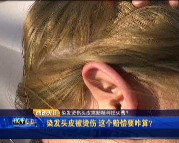 染发把头皮染破了要怎么赔偿,理发店烫伤头皮如何赔偿