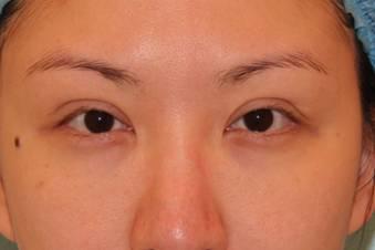 想要双眼皮就双眼皮吗,眼睛小割双眼皮是不是会好看很多