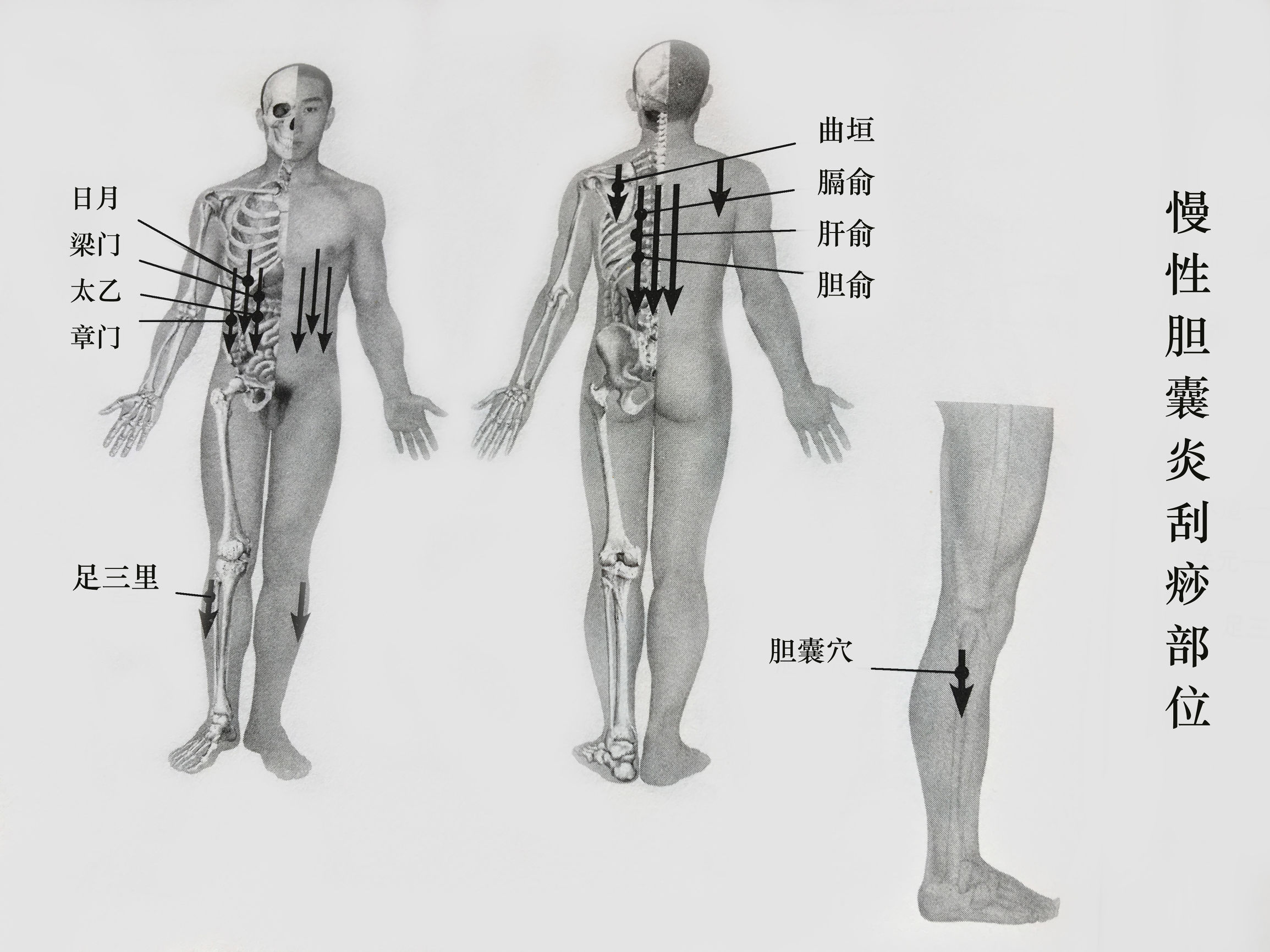 胆囊炎结石能不能刮痧拔罐,胆结石胆管炎胆囊炎中医能治愈吗