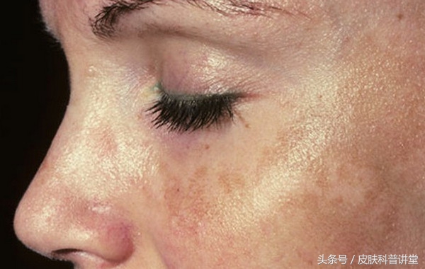 什么原因会长褐青斑,褐斑越来越多是什么原因