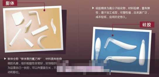 鼻子做假体多久才能恢复正常,鼻子做假体增生了怎么办