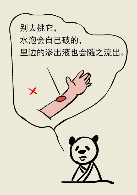 做饭时被热油烫伤怎么办,做饭被油烫伤了怎么办会留疤吗