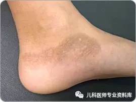 湿疹后有白斑是怎么回事,湿疹后白斑是白癜风