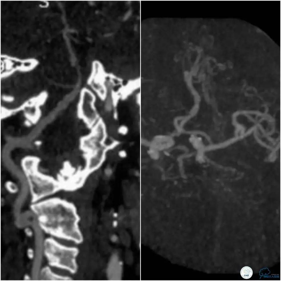 天坛周记|基底动脉狭窄合并动脉瘤血管内介入治疗一例