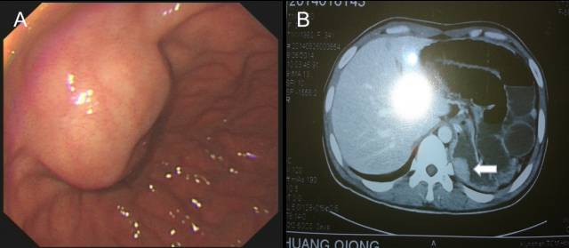 当EUS遇到“假瘤子”(二)——都是“隔壁老王”惹的祸(毗邻外压)