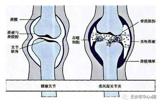 治疗类风湿关节炎的老中医,中医治疗类风湿关节炎案例