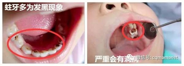 一般小孩几岁换牙齿才正常呢,十岁左右儿童牙齿常见问题