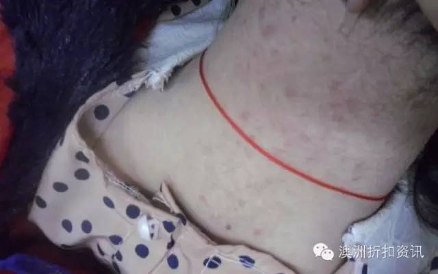 benzac祛痘膏使用方法,benzac祛痘膏测评