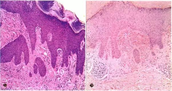 全身角化病,全身出现多处皮肤癣是什么引起的