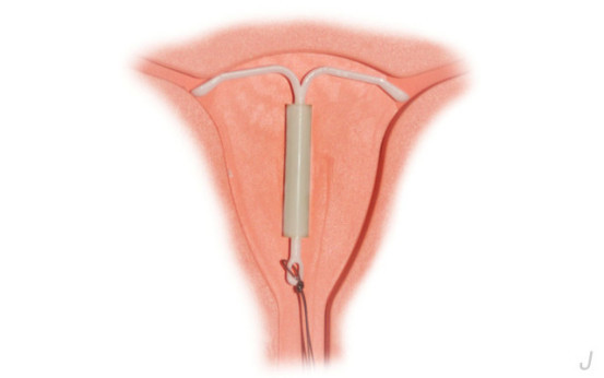 女人上环痛，可更痛的是取环，取环的全过程你敢看吗？