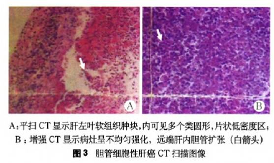 病检嗜酸性粒细胞增多提示啥病,嗜酸性粒细胞升高并且腹痛