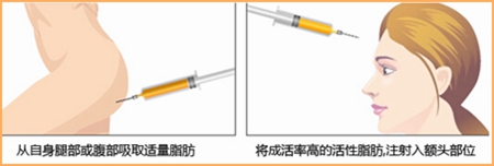 自体脂肪可以填额头吗,广东自体脂肪丰额头