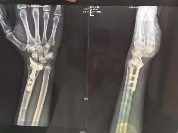 为什么玩滑板老是要摔倒,玩滑板摔倒有多严重