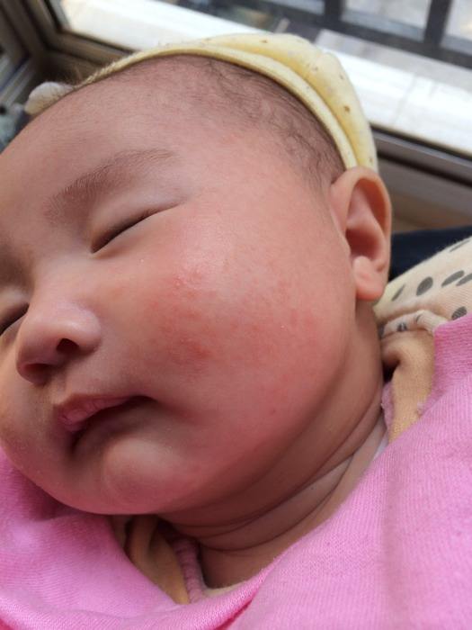 湿疹怎么办最有效的方法,湿疹怎么办知乎