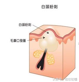 面部白头闭口粉刺怎么去除,最严重的粉刺消除方法