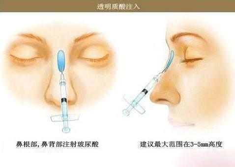 鼻子做假体隆鼻有什么坏处,隆鼻以后老了鼻子会怎样