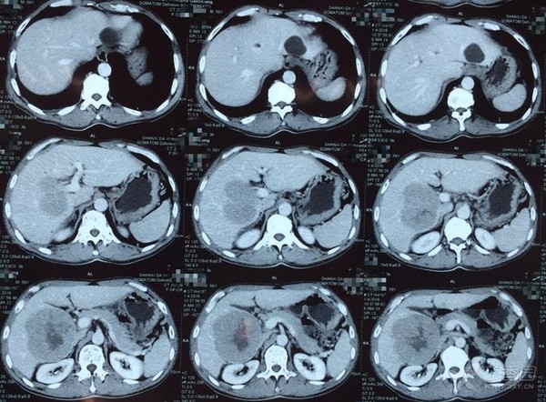 贲门癌转移肝癌4期是什么程度,得了贲门癌和肝癌能活多久