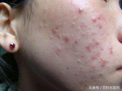 肝火旺的10大常见表现,肝火旺的10大症状及调理方法