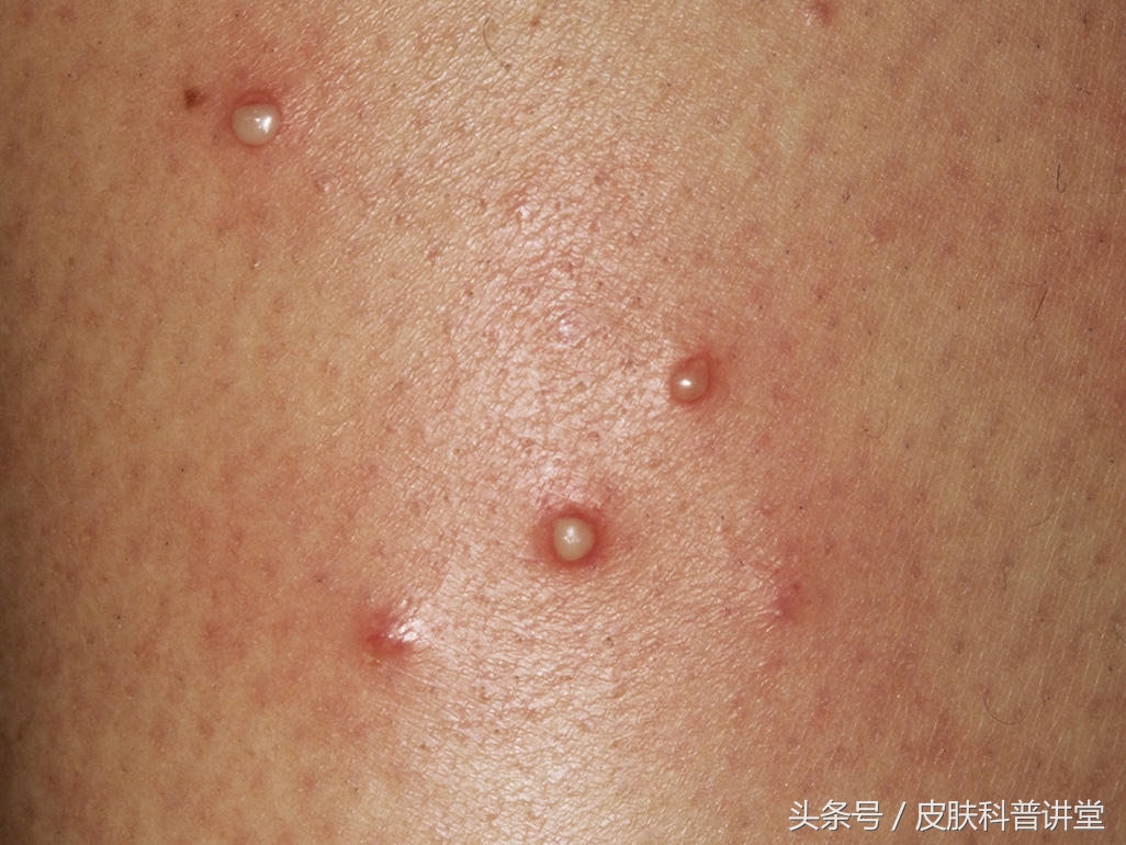 皮肤毛囊炎最简单自愈方法,皮肤科普小讲堂第一讲