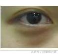 黑眼圈真的就没办法了吗,黑眼圈真的没办法了吗