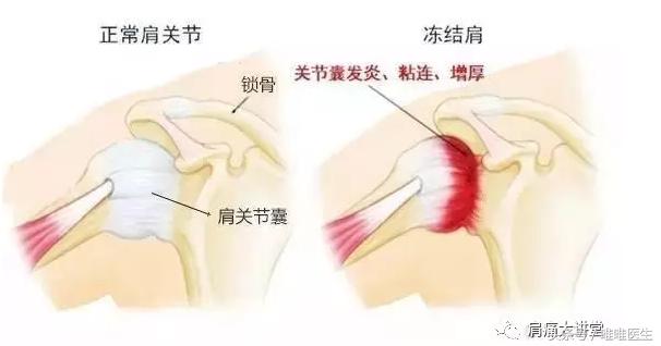 肩周炎积水潭专家,肩周炎医生讲解