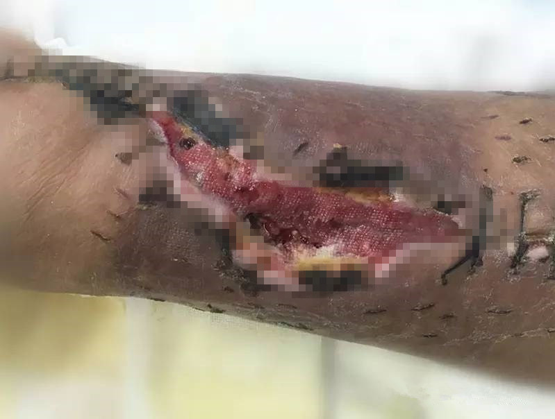 术后刀口露钢板不愈合中医疗法,术后伤口有个小洞一直不愈合