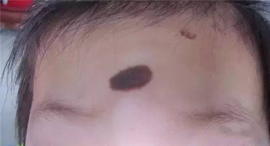 哪些胎记有危险,宝宝胎记是什么原因造成的