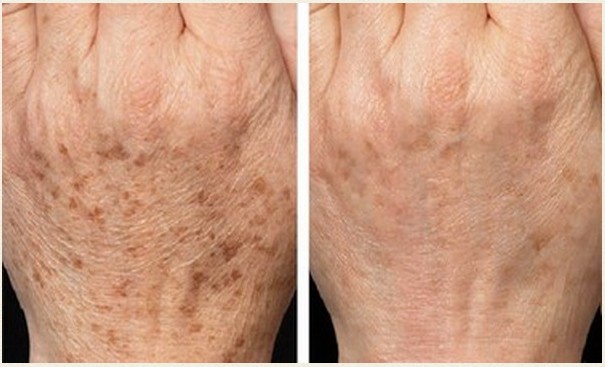 突然长出黑斑怎么去除最有效,以前长的黑斑怎么能去掉