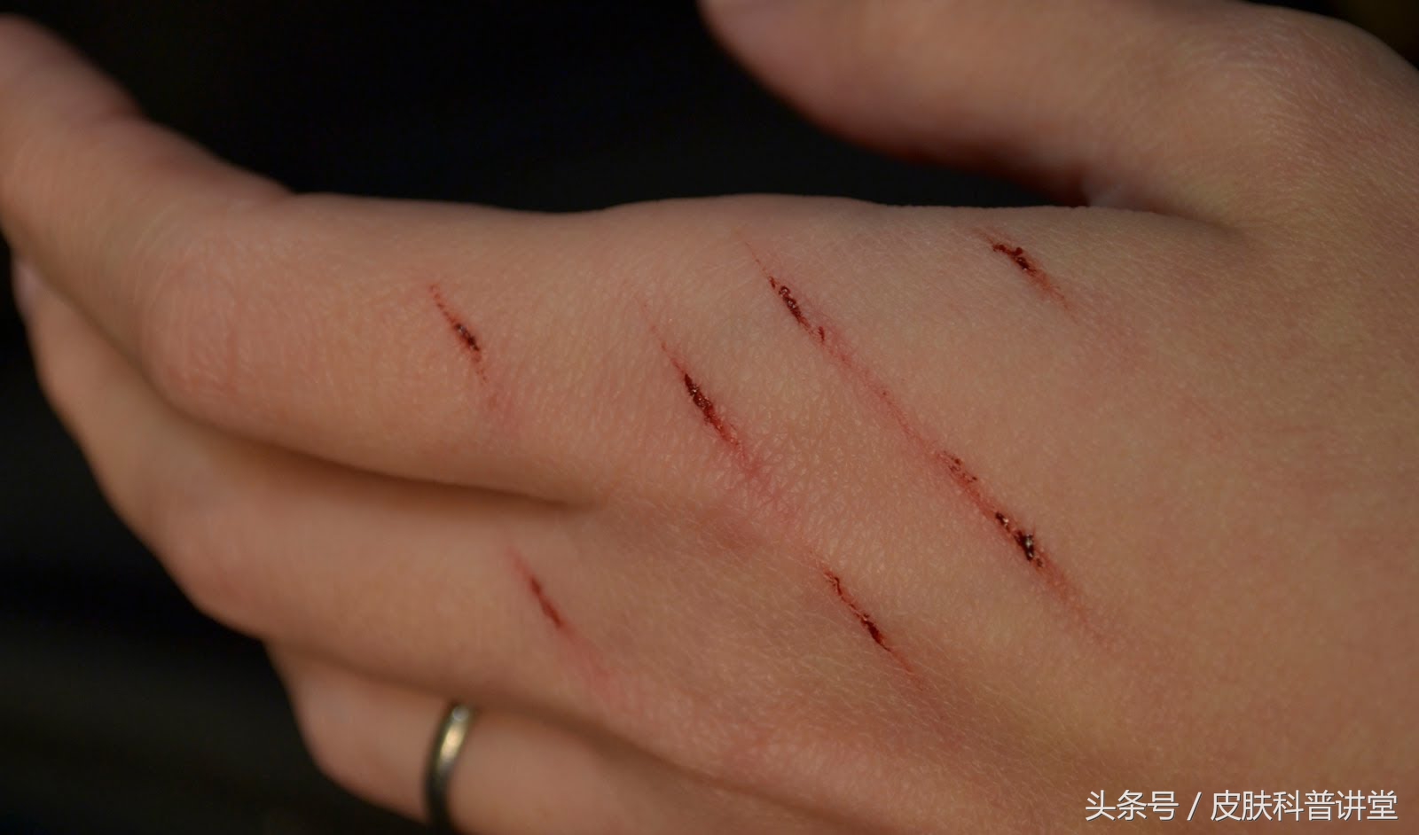 有没有被猫抓过,那你可要留意一下这个皮肤病了,猫抓病