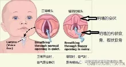 先天性喉喘鸣会影响说话吗,妈妈锦囊