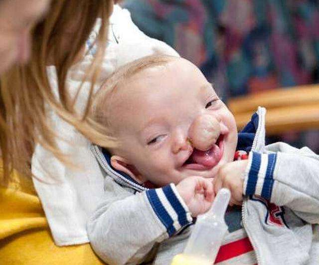 一个小孩一出生就长着猪鼻子,刚出生的婴儿猪鼻子