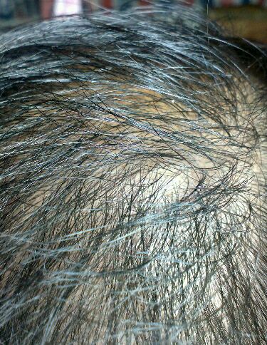 年轻人头顶脱发能恢复是真的吗,为什么现在的人脱发掉发严重