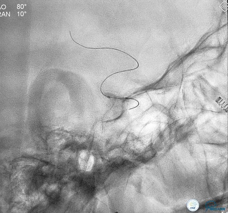 支架辅助弹簧圈栓塞治疗狭窄伴复杂动脉瘤