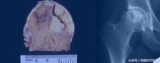 股骨头坏死不治后果是什么,股骨头坏死长期不治有什么后果