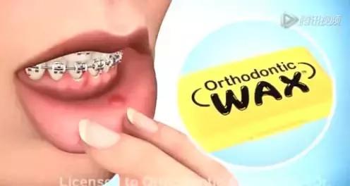 矫正钢丝末端扎嘴怎么解决,矫正钢丝末端扎嘴在家怎么办