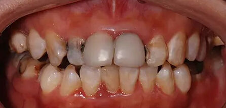 牙齿有缝隙怎么矫正,牙齿清洁缝隙的有效方法