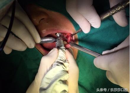 种植牙到底有多痛苦,种植牙真实经历详细全部过程