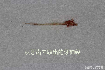 牙齿上药杀神经全过程,儿童牙齿杀神经的步骤