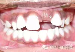 恒牙换牙不,恒牙不长出